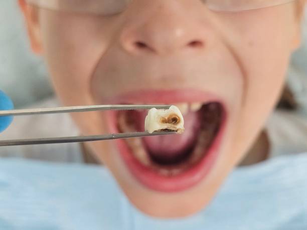Best Emergency Treatment for Toothache in Jasper, TX